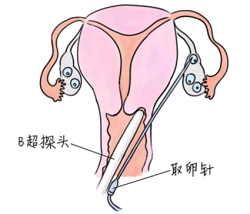 小儿退烧推拿手法 5种厦门捐卵宝宝退烧按摩方法